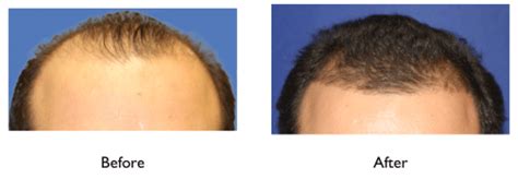From $449 per 1 session. micro-needling results hair regeneration Dr Amiya Prasad ...