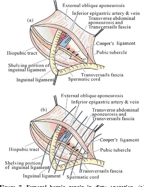 Femoral Hernia A Review Of The Clinical Anatomy And Surgical Treatment Semantic Scholar
