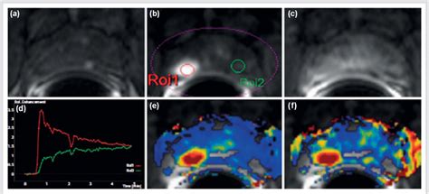 Dynamic Contrast Enhanced Magnetic Resonance Imaging Mri Dynamic