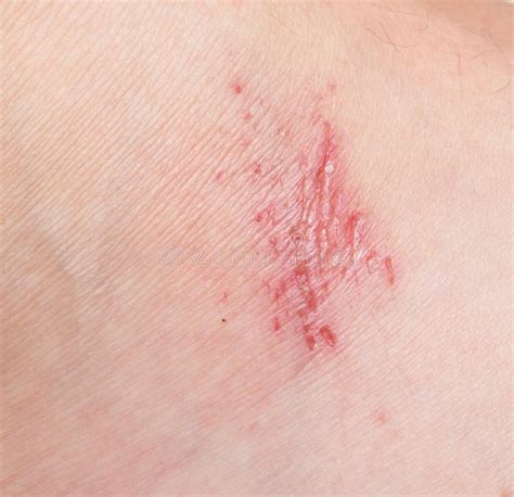 Wound On Skin Stock Photo Image Of Knee Scar Injury 102212214