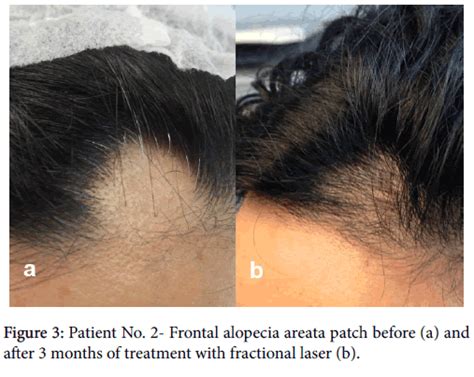 This can then allow the hair follicles to function normally again for hair to regrow. cosmetology-trichology-Frontal-alopecia-areata