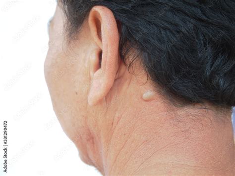Sebaceous Cyst On The Neck Man Form Out Of Sebaceous Gland The Oil
