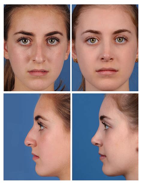 Rhinoplasty Before And After Photos