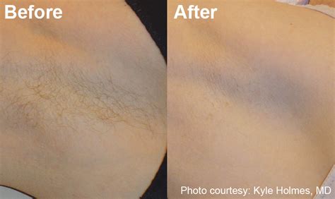 Many factors need to be considered to determine the cost, like the type of laser used (alexandrite, diode, nd: Laser Hair Removal - Optiskin