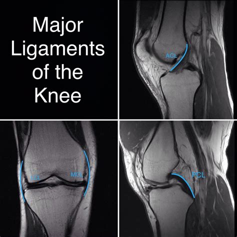 Knee Mri Artofit