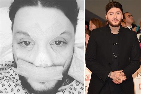 james arthur pictured covered in bandages after having a nose job following too many scuffles