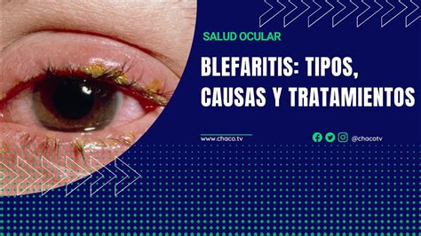Blefaritis Tipos Causas Y Tratamientos Youtube