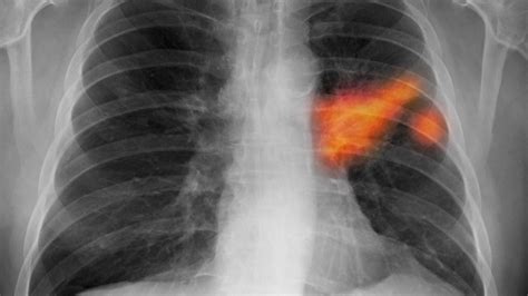 Map reveals those living in the north are at almost cancer research uk showed the different lung cancer rates in different regions and people from the north east have double the risk of those in the south west people living in the north have almost double the chance of developing lung cancer, shocking. Lung Cancer Surgery Worthwhile for Older Patients ...
