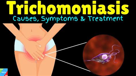 Trichomoniasis Causes Symptoms Diagnosis Treatments And Prevention Youtube