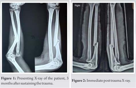 Old Monteggia Fracture Dislocation Treated With Plating And Forearm