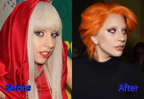 Lady Gaga Nose Job Before After