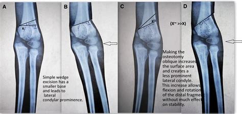 References In Triple Modified French Osteotomy A Possible Answer To