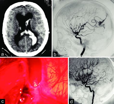 A Axial Ct Scans Detecting A Right Intraventricular Hematoma In A
