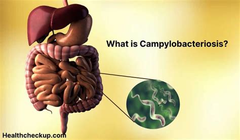 Campylobacteriosis Symptoms Diagnosis Treatment Prevention