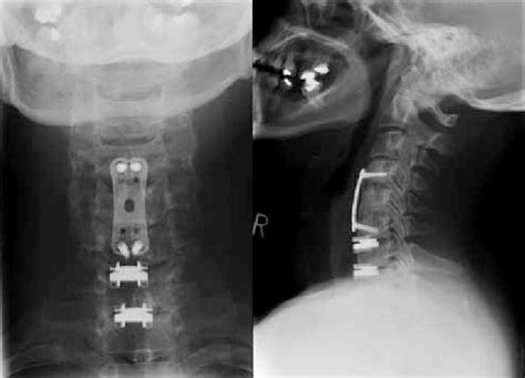 Figure Radiographs Showing Previous Anterior Cervical Discectomy And