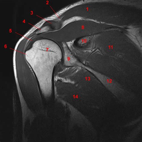 Mri Musculo Skeletal Section Mri Shoulder Coronal View Findings