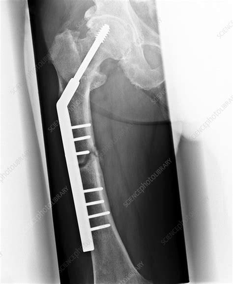 Pinned Hip Fracture X Ray Stock Image C0095258 Science Photo