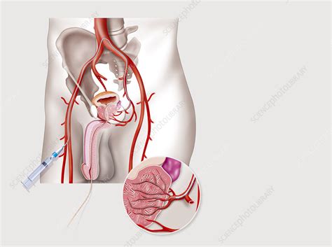 Prostatic Artery Embolization Stock Image C Science Photo