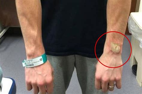 Man Describes Horrifying Moment Fitbit Exploded On His Wrist Leaving Him With 3rd Degree Burns