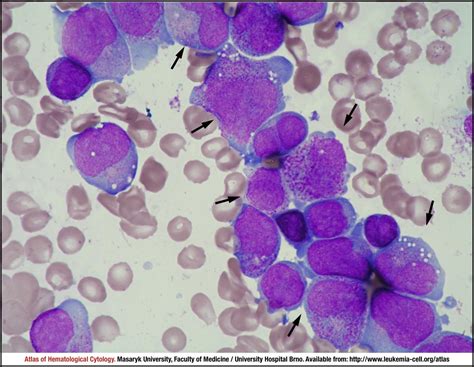 Chronic Myeloid Leukaemia Cml Bcr Abl1 Positive Blast Phase