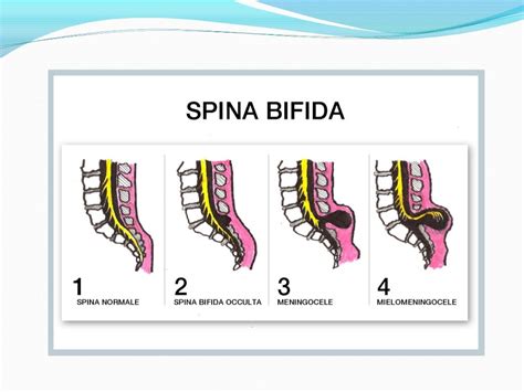 Hydrocephalus And Spina Bifida