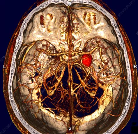 It often looks like a berry hanging on a stem. Cerebral aneurysm, CT scan - Stock Image - M136/0212 ...