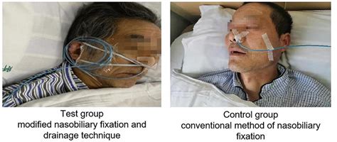 Frontiers Randomized Controlled Trial Of Modified Nasobiliary