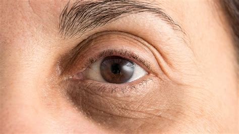 What Causes Dark Circles And What Treatments Are There