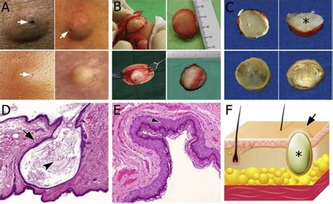 Overview Of Epidermoid Cyst European Journal Of Radiology Open