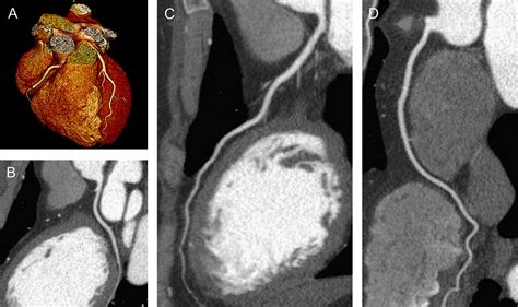 Current Applications And Limitations Of Coronary Computed Tomography