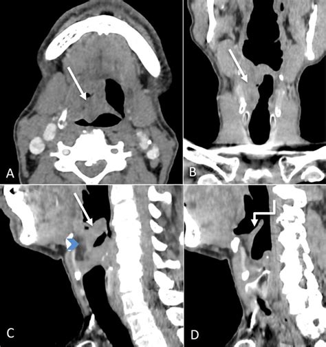 Supraglottic Laryngeal Cancer Axial Coronal And Sagittal Ct Images