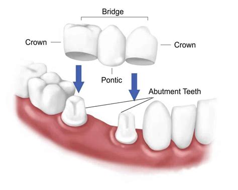 Dental Bridges Elite Dental Group