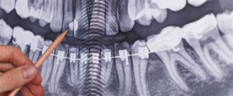 Dental X Rays In Cedar Park What Are They And Why Are They Important