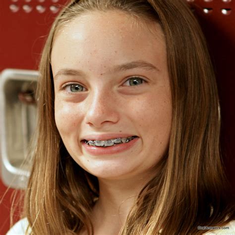 60 Photos Of Teenagers With Braces Jonasultton