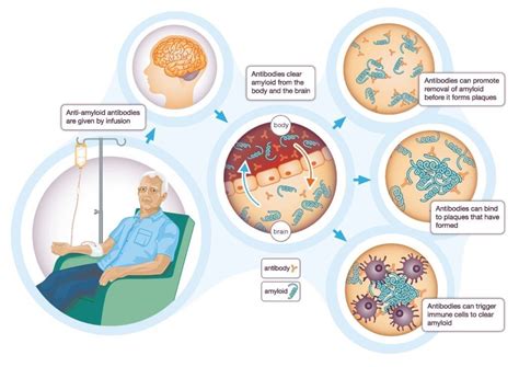 Aducanumab targets the underlying cause of alzheimer's, the most common form of dementia, rather than its symptoms. Behind the headlines: Is a new Alzheimer's treatment in ...