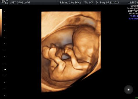 Die ersten babysachen putzen gewinnspiel bonavi air 22 ssw mslavender. 3D / 4D Ultraschall - Pränataldiaknostik