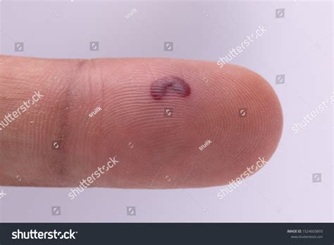 Blood Blister Under Finger Skin Stock Photo 1524603893 Shutterstock