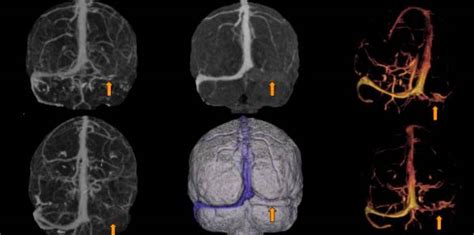 La Trombosis Venosa Cerebral Explicada En Lenguaje Simple