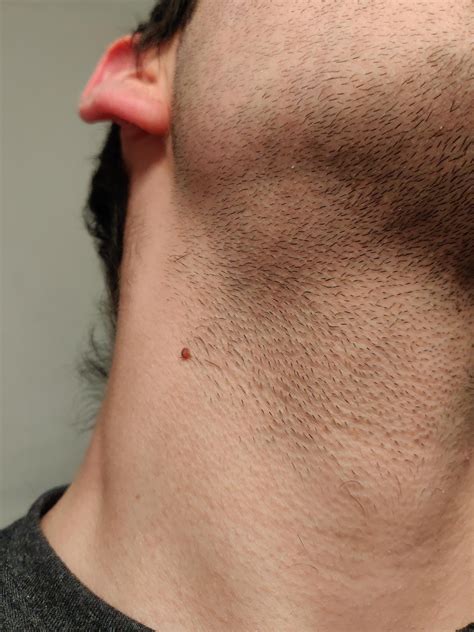 Swollen Lump Lymph Node Under Jaw Makes Jawline On One Side Look Bad