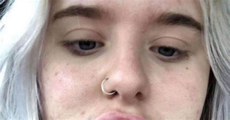 Scots Woman Left With Botched Lips In Filler Hell After Being