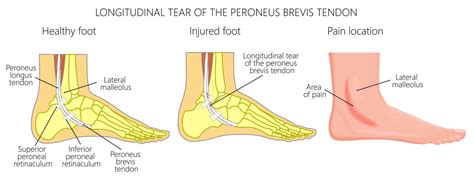 Peroneal Tendon Tear Diagnosis Treatment And Surgery