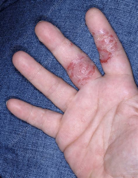 Dyshidrotic Eczema Fingers