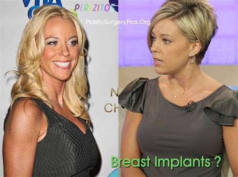 Kate Gosselin Plastic Surgery Before And After