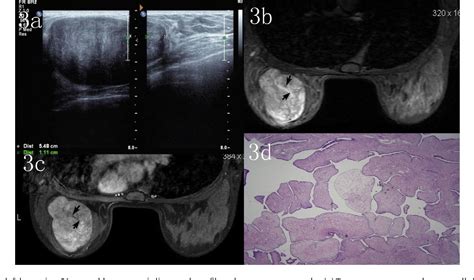 Figure 4 From Imaging Findings In Phyllodes Tumors Of The Breast