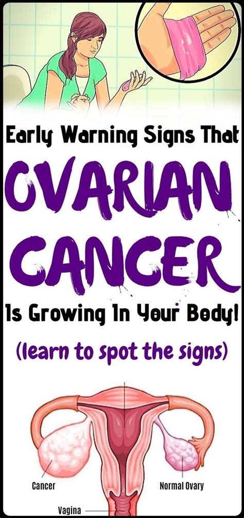 Early Silent Signs Of Ovarian Cancer You Might Be Ignoring Healthy Tray