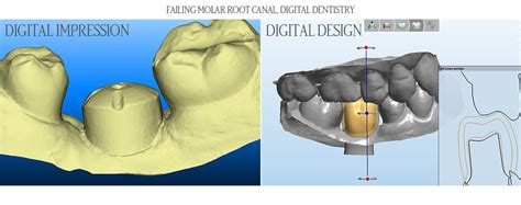 Before And After Gallery Asird American Society Of Implant And