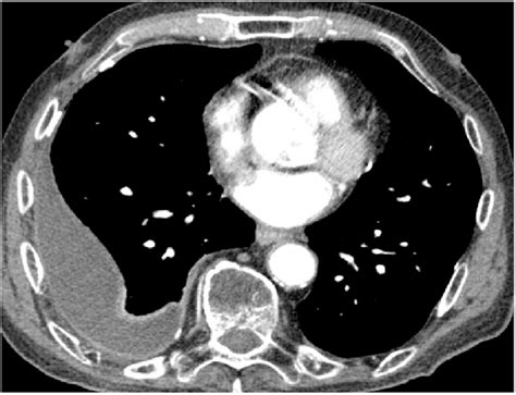 Chest Ct Scan Showing A Loculated Right Sided Pleural Effusion With