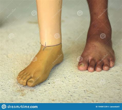False Legs For Amputated Persons Stock Image Image Of Femate Legs