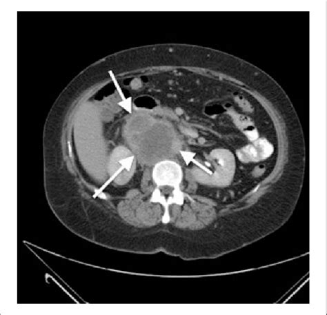 The Retroperitoneal Mass Can Be Seen Between The White Arrows