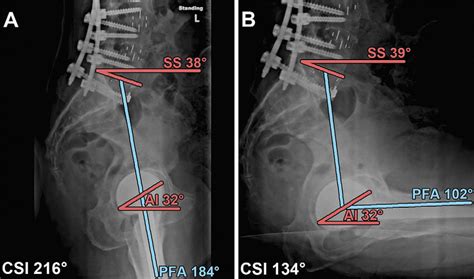 A And 4 B Standing And Sitting Lateral Spine Pelvis Hip Radiographs Of